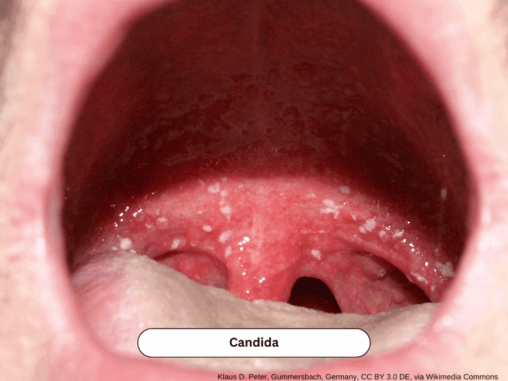 Pharyngeal candidiasis with white patchy lesions on erythematous mucosa consistent with oral thrush