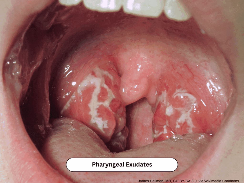 Tonsillar exudates and pharyngeal erythema consistent with streptococcal pharyngitis
