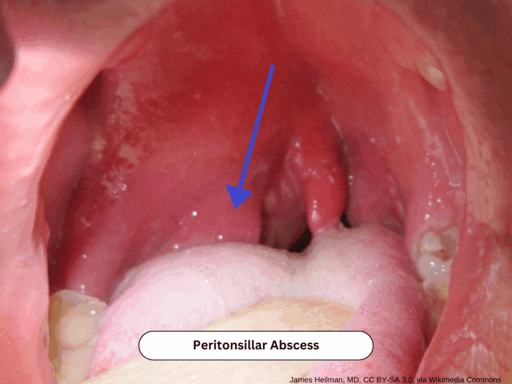 Oropharyngeal exam showing peritonsillar abscess with uvular deviation and tonsillar swelling