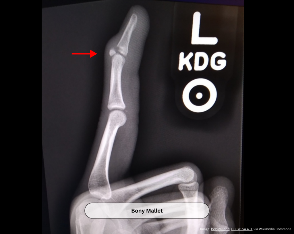 mallet finger avulsion fracture distal phalanx x-ray