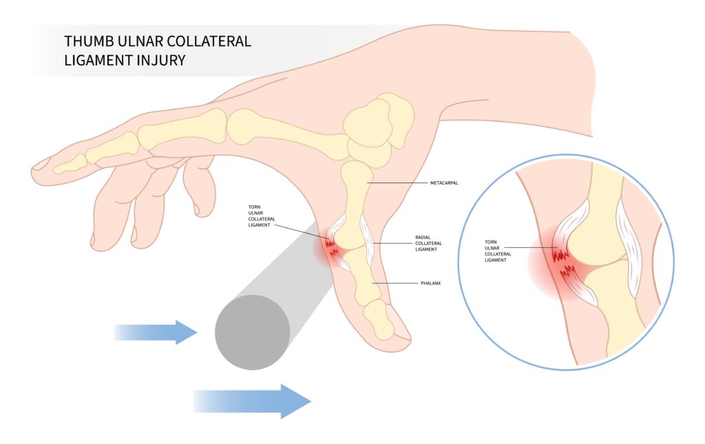 thumb ulnar collateral ligament injury skier’s thumb exam