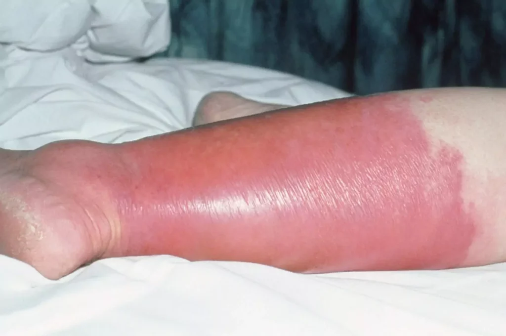 Lower leg with redness and swelling being assessed for cellulitis vs other diagnoses