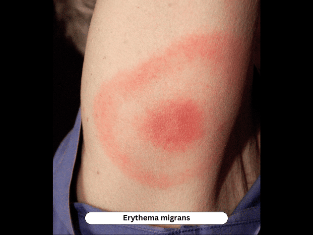Expanding bull's-eye lesion at tick bite site — Lyme disease erythema migrans