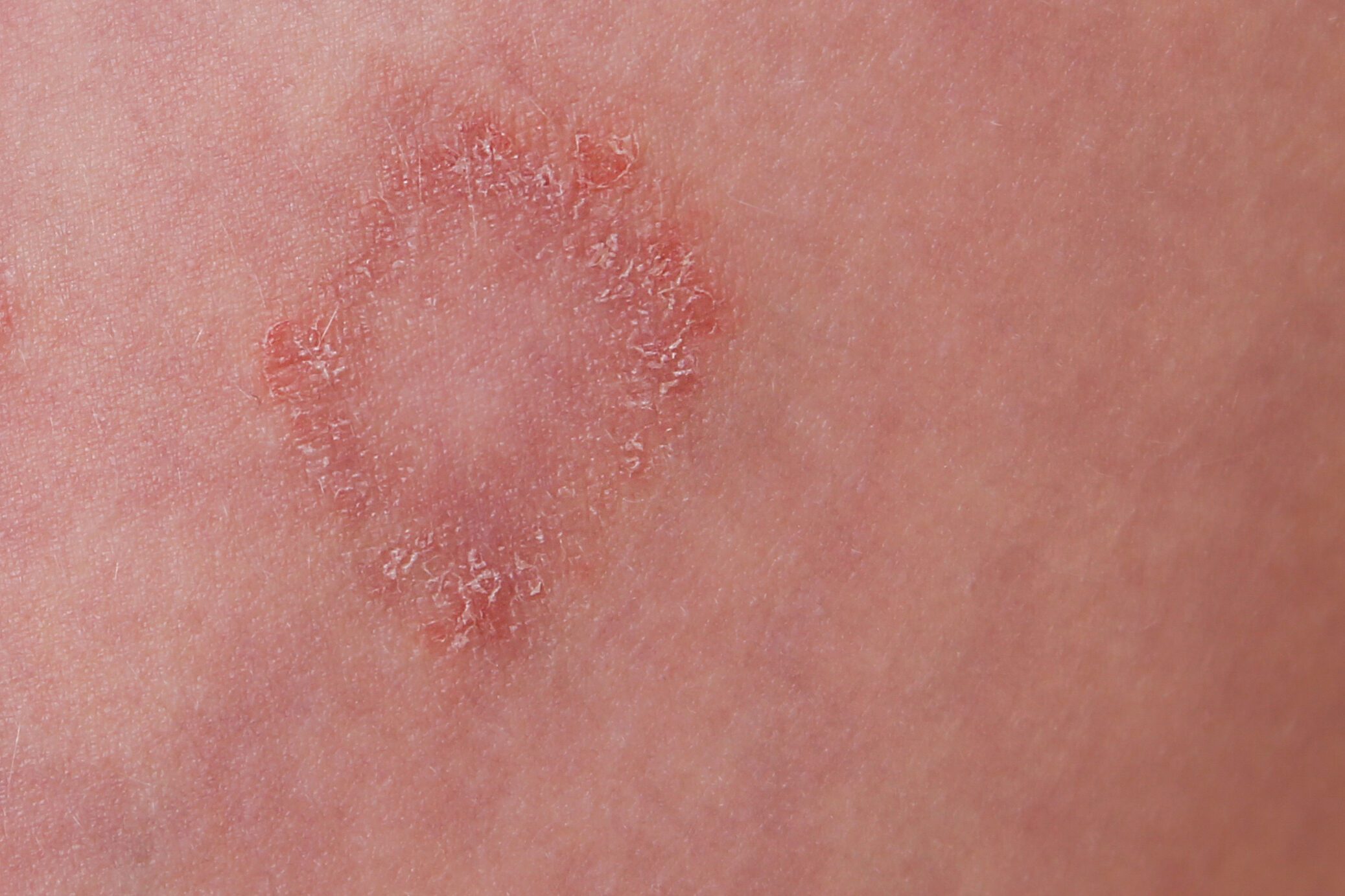 Annular scaly plaque with central clearing on forearm — tinea corporis