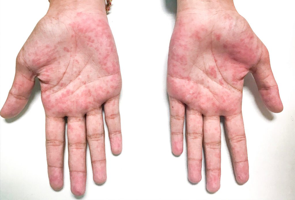 Petechial rash on palms — Rocky Mountain Spotted Fever