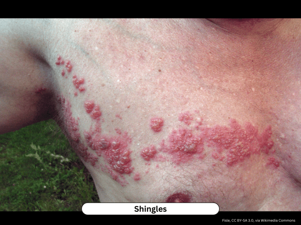 Grouped vesicles in unilateral dermatomal distribution — herpes zoster