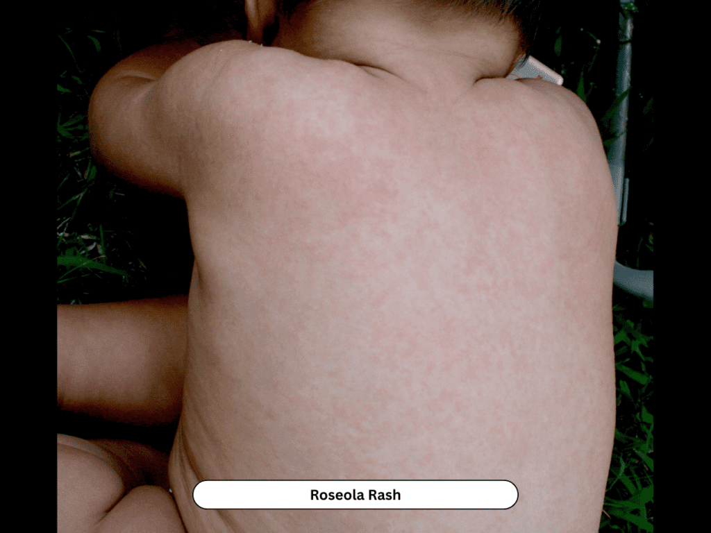 Pink maculopapular rash on trunk in child with viral exanthem